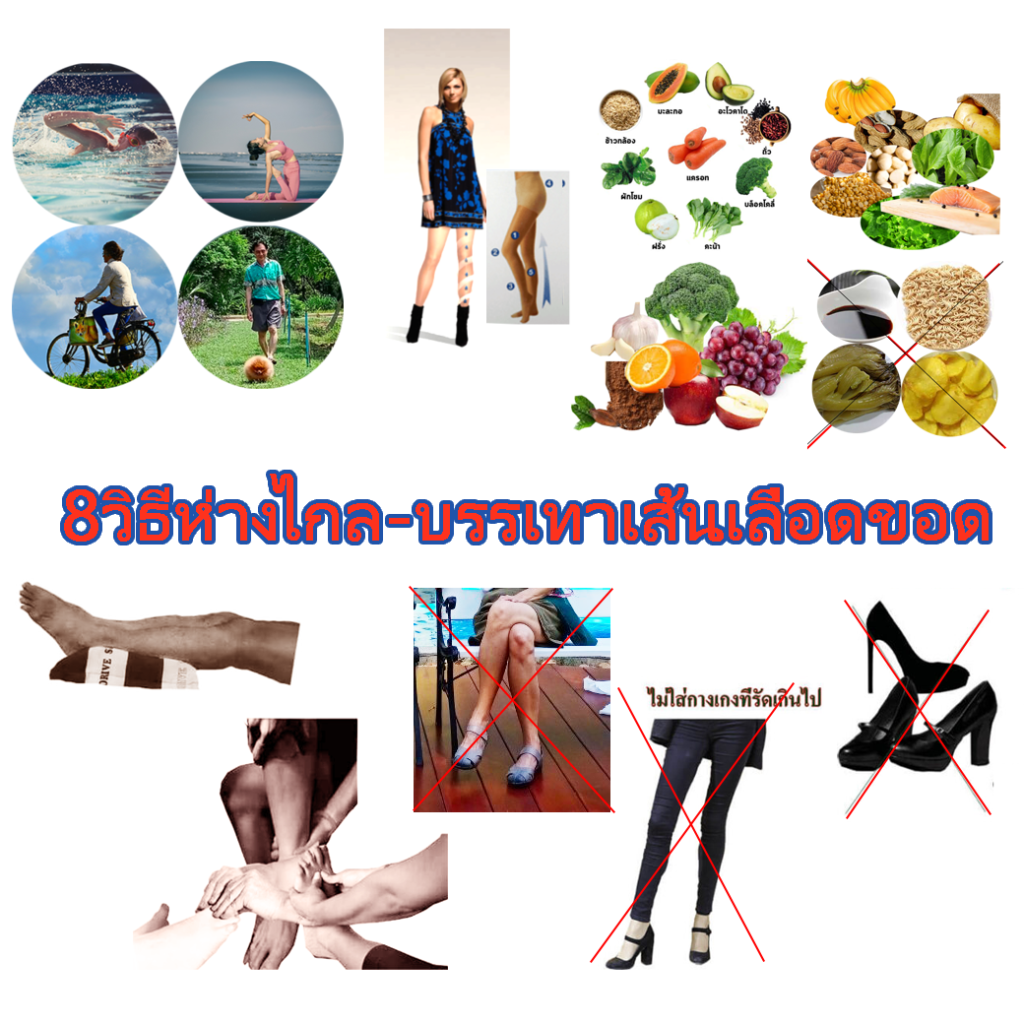 ป้องกัน-บำบัดอาการจากเส้นเลือดขอด